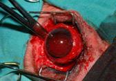 13.- Se clampa con una pinza de forcipresión (mosquito) la arteria oftálmica y el nervio óptico.