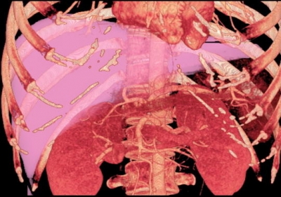 Volumen ocupado por el hgado (en rosa) en una imagen de tomografa computerizada 
